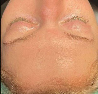 Botox